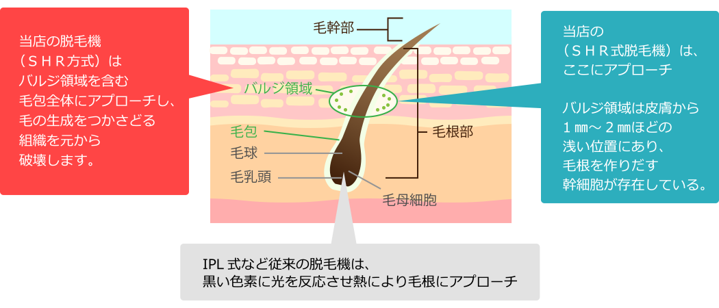 ◆ ムダ毛の生成工場　バルジ領域を攻める ◆