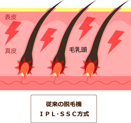 従来の脱毛機 ＩＰＬ・ＳＳＣ方式