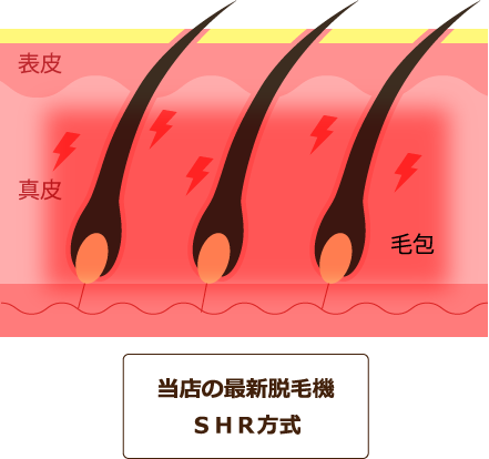 当店の最新脱毛機 ＳＨＲ方式